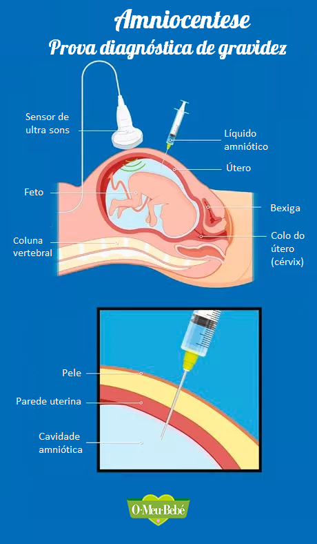 Amniocentese omeubebe