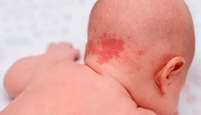 Angiomas e hemangiomas
