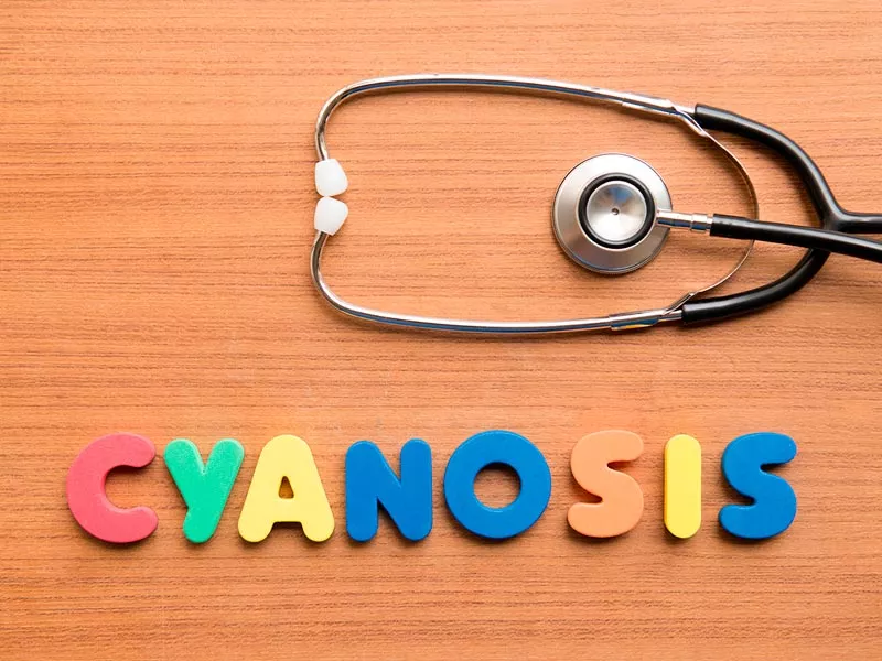 Cianose ou doença azul: causas, diagnóstico e tratamento