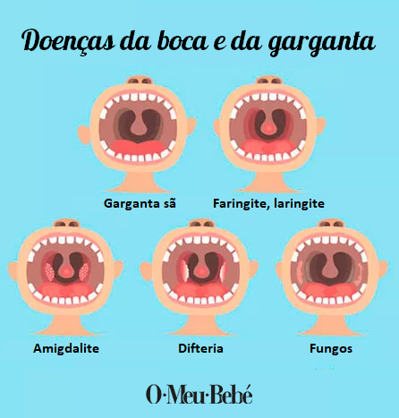 Doenças boca garganta