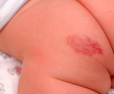 angioma bebe