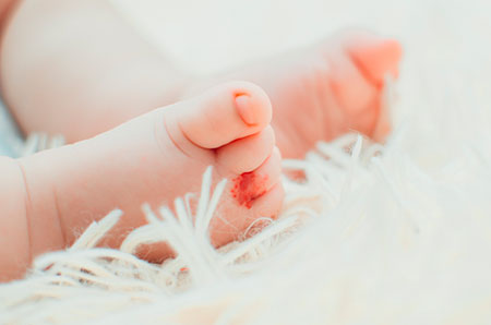 angioma bebe2