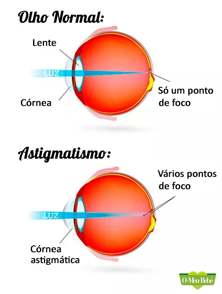 astigmatismo info