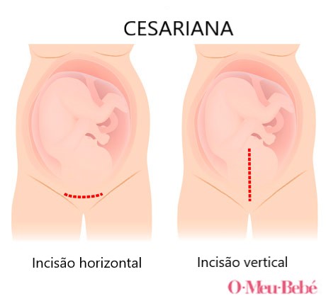 cesariana incisao infografia