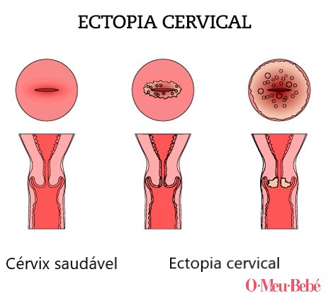 ectopia cervical