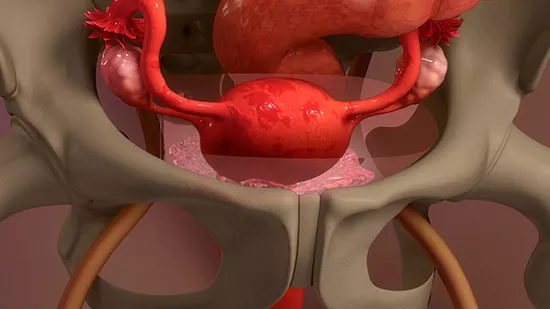 endometriose 3d