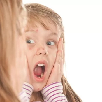 Herpes Labial Nas Criancas Causas E Tratamentos O Meu Bebe