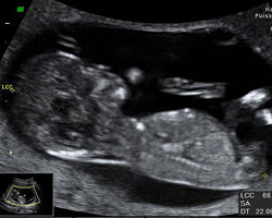 ecografia bebe semana 13ok