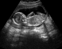 ecografia bebe semana 15ok