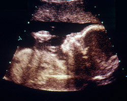 ecografia bebe semana 23ok