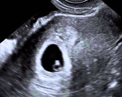 ecografia bebe semana 3ok