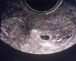 ecografia bebe semana 5ok