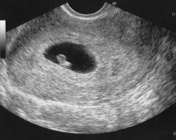 ecografia bebe semana 6ok