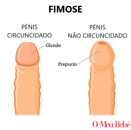 infografia fimosis