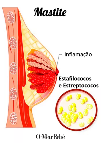 mastite
