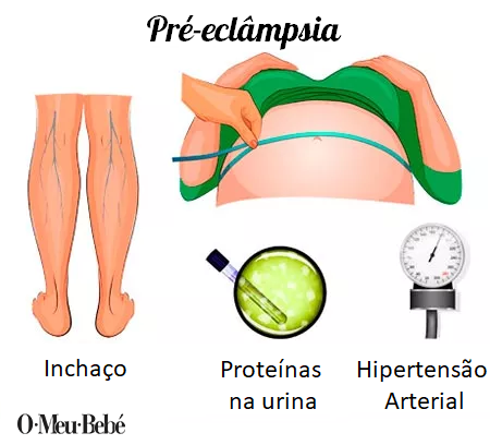 preeclampsia pt