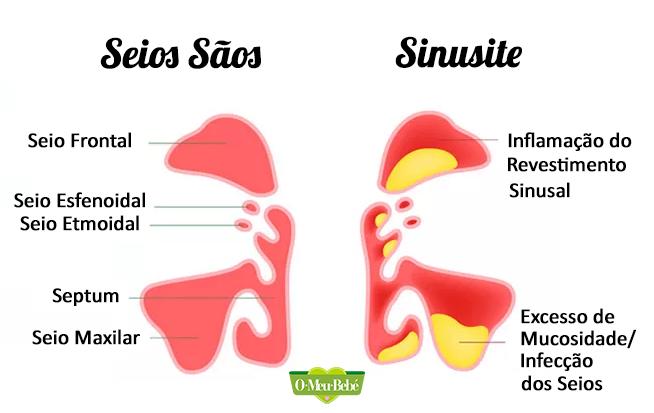 sinusite o meu bebe